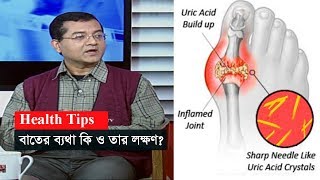 বাতের ব্যথা কি ও তার লক্ষণ? | Health Tips | Gout Pain | Somoy TV image