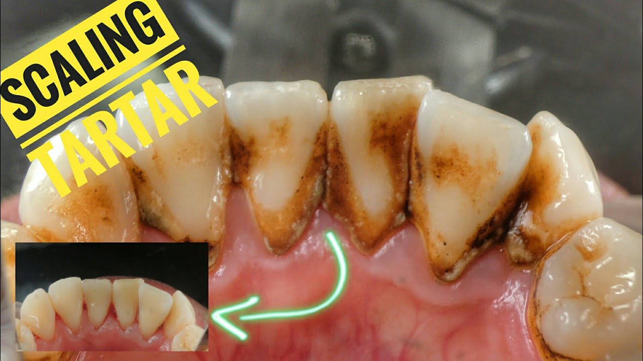 Scaling Calculus Dental Tartar Removal Dentist Dokter Gigi