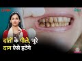 दांतों पर लाल, भूरे, पीले दाग हैं? Teeth Stains घर पर ही साफ़ करने का मारक तरीका ये रहा | Sehat