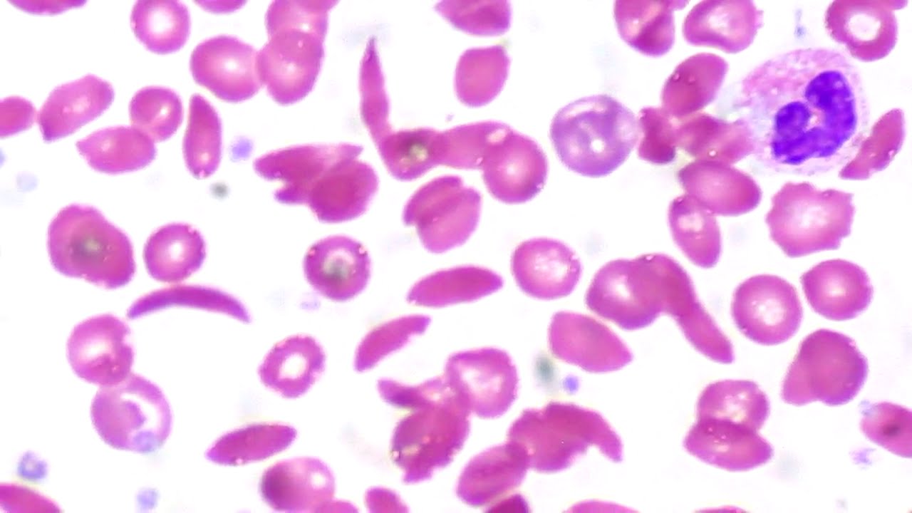 Серповидно-клеточная анемия – не доказательство эволюции