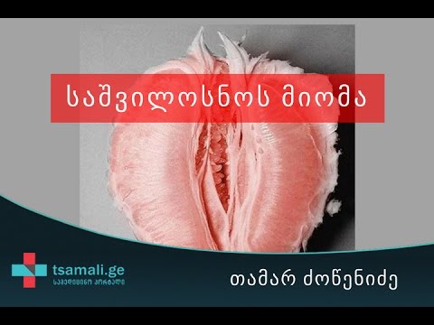 საშვილოსნოს მიომა - საუბრობს თამარ ძოწენიძე