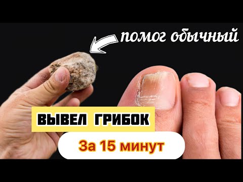 ГРИБОК НОГТЕЙ можно убрать за 15 минут обычным... Это есть дома у каждого