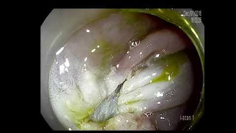 Learning from the Pitfalls. EMR of Large flat polyp- Mohamed Othman M.D.