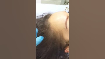 female SMP Healed after 1 session Scalp Micropigmentation density by El Truchan @ Perfect Definition