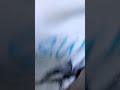 احتقان اوردة الرقبة من اهم العلامات السريرية التي تساعد في تشخيص امراض القلب والصدر#يوميات_طبيب