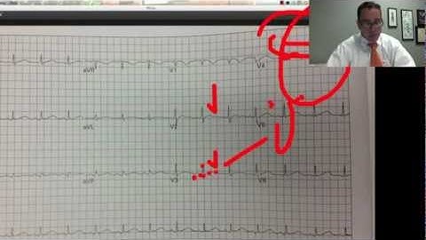 EKG EMS lecture part 2