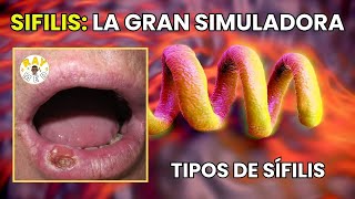 Sífilis Primaria, Secundaria Y Terciaria Brevemente