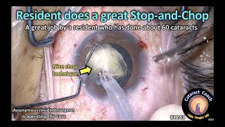 CataractCoach 1243: resident does a great stop-and-chop cataract surgery