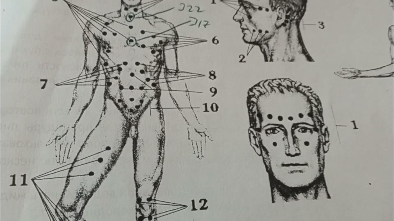 Гипертония точки. Схема постановки пиявок. Точки постановки пиявок. Точки постановки пиявок на ноги.