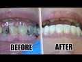 Live tooth cavity removal treatment for extensive tooth decay