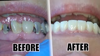 Live: Tooth Cavity Removal (Treatment For Extensive Tooth Decay)