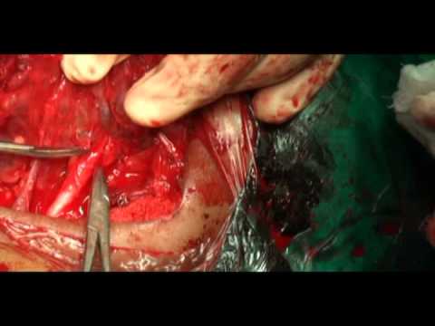 Videó: Operáció A Hygroma Eltávolítására: Előkészítés, Szakaszok, Szövődmények