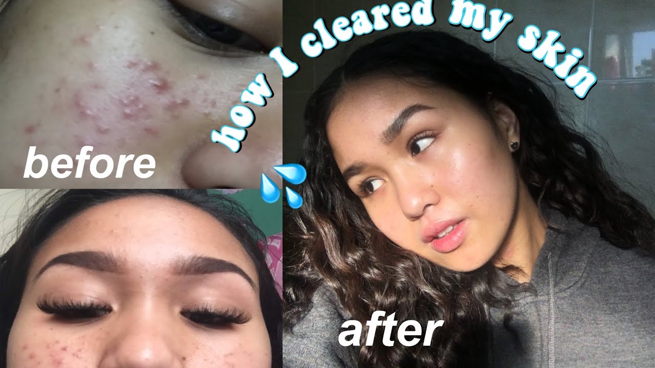 how to get clear skin // how I cleared up my breakouts + current ...