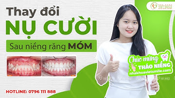 Niềng răng tại nha khoa uy tín bạn được gì? - KH. Lê Thùy Dung