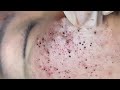 HANA #74: AN AWESOME BLACKHEADS FIELD