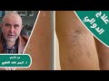 الاسباب و الطرق الطبيعية لعلاج الدوالي مع الدكتور كريم عابد العلوي الاسباب و الطرق الطبيعية لعلاج الدوالي مع الدكتور كريم عابد العلوي
