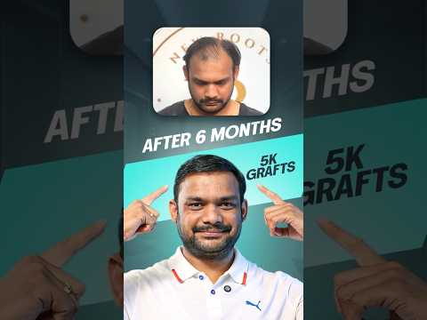 Hair Transplant in Hyderabad (6 Months Result) | 5000 Grafts Implanted #shorts