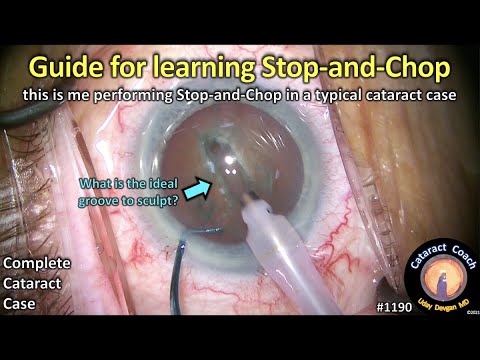 CataractCoach 1190: learning the stop and chop phaco technique