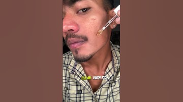 Day 15 Of Using Man Matters Minoxidil 5% for Beard Growth 😉 #beardgrowth #minoxidilresult #viral