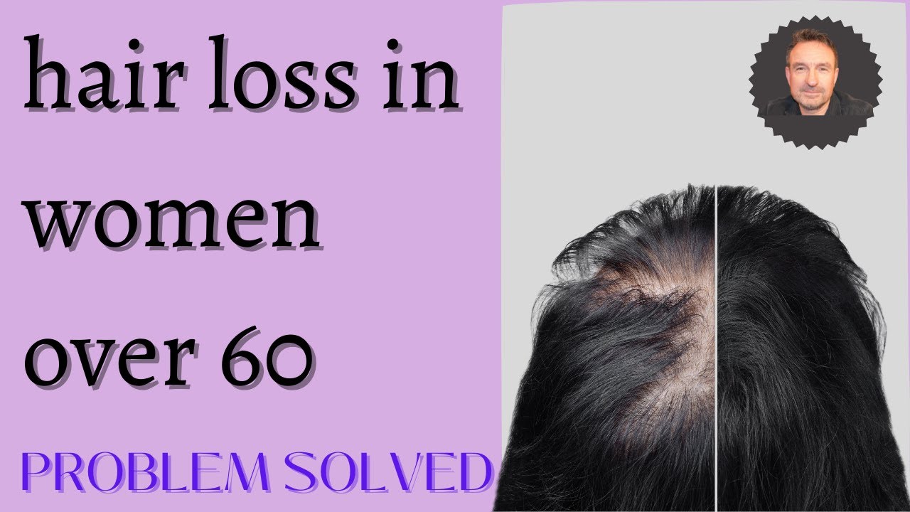 Hair Loss In Women Over 60 10 Treatments To Solve Plus Bonus One Youtube