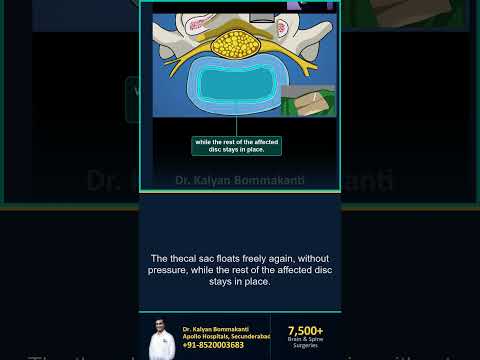 Even a Migrated Disc Fragment Can Be Reached — Best Endoscopic Spine Surgeon, Hyderabad