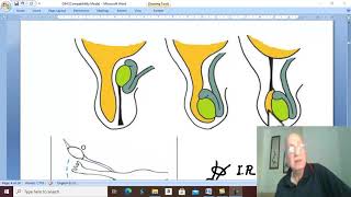 Hernia in Arabic 10 ( Indirect Inguinal hernia , part 1 ) , by Dr. Wahdan