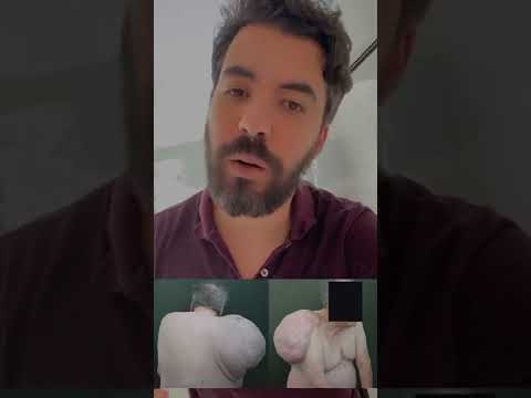 ما هو الورم الشحمي وهل يجب إزالته