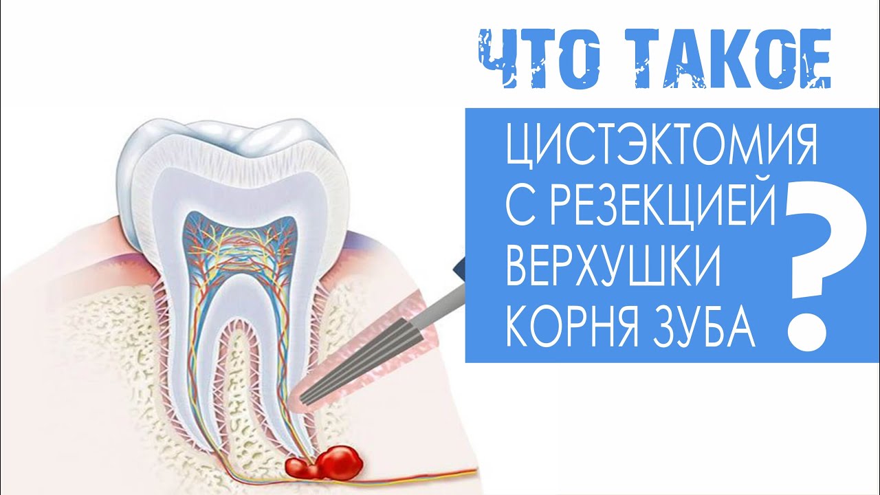 Цистэктомия с резекцией верхушки корня зуба - YouTube
