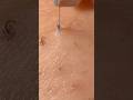 毛穴のゴミすごいな！？！？ #hairremoval #blackheads #毛抜き #satisfying #tweezers #脱毛 #毛穴
