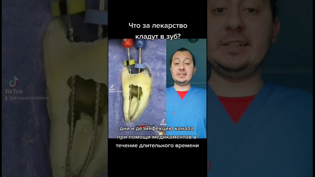 Что за лекарство кладут в зуб? #стоматолог #дантист #стоматология #зубнойврач #зубы #баку #dişhekimi