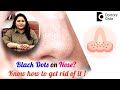 Black dots on the nose know how to treat them  blackhead   drtina ramachander  doctors circle