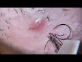 Plucking facial hair & ingrown hair 826 頬髭抜き(埋没毛あり)