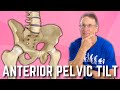 Anterior Pelvic Tilt? Do You Have It?  How to Fix? A  BIG SURPRISE!