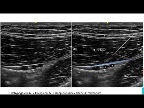 Video: Ilioinguinal Hermon Anatomia, Toiminta Ja Kaavio - Vartalokartat