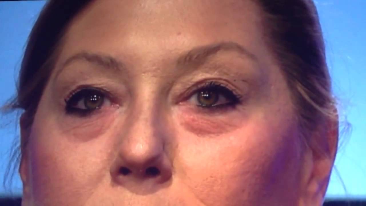 2 MINUTE Remedy to get rid of Eye Bags, Puffiness & Wrinkles!! 