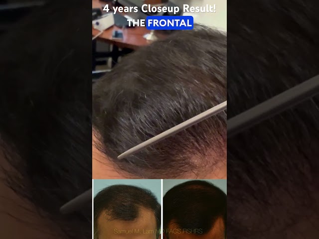 Four Years After Close-Up, Comb-Through Hair Transplant Result for Indian Patient in Dallas, Texas
