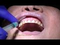 Prepless veneers at cosmetic dental associates in san antonio tx