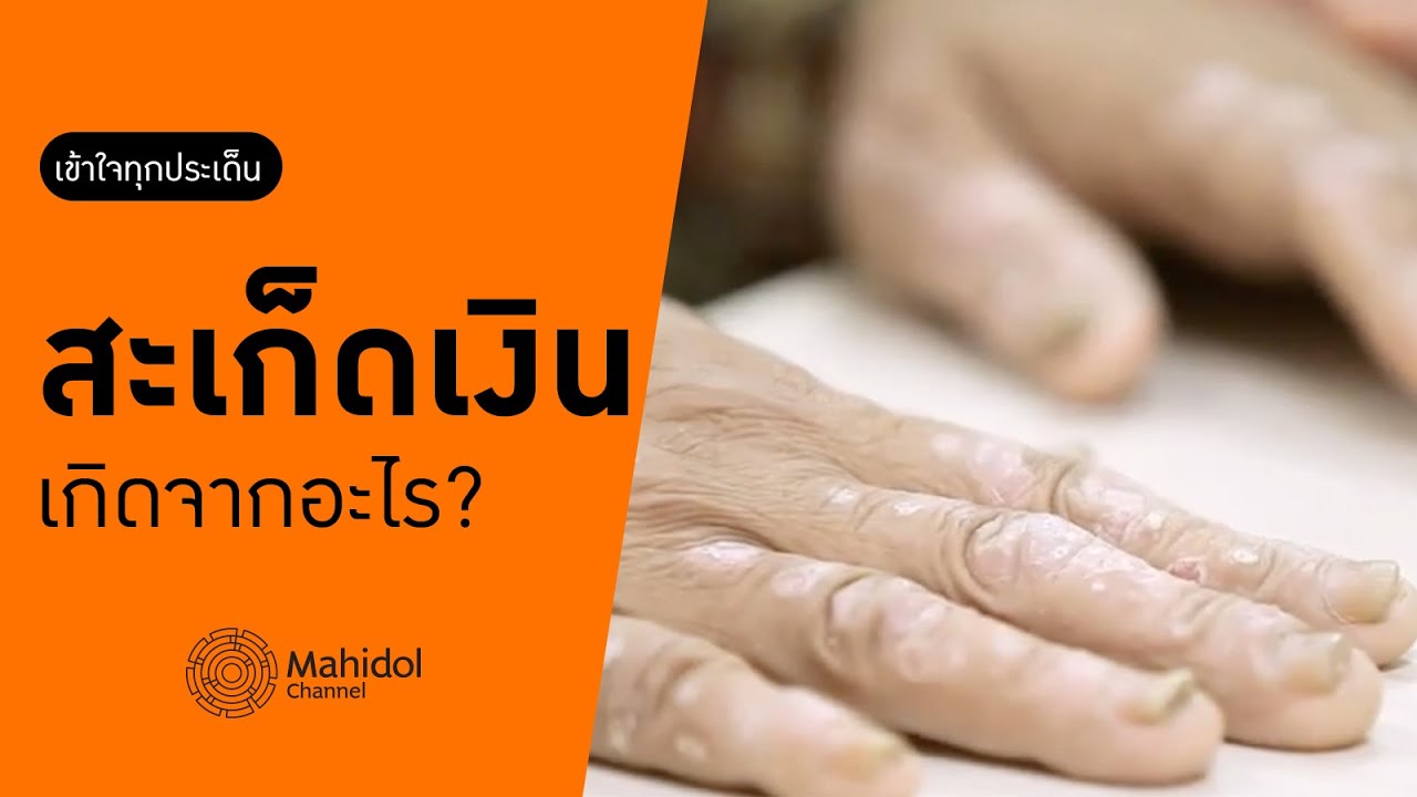 'สะเก็ดเงิน' รักษาอย่างไร? [หาหมอ by Mahidol Channel]