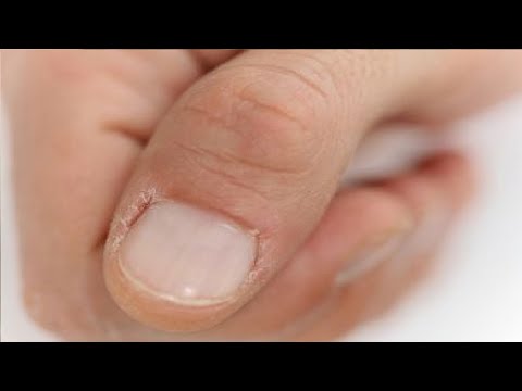 Peeling skin below finger nails. What could be the problem? - Quora