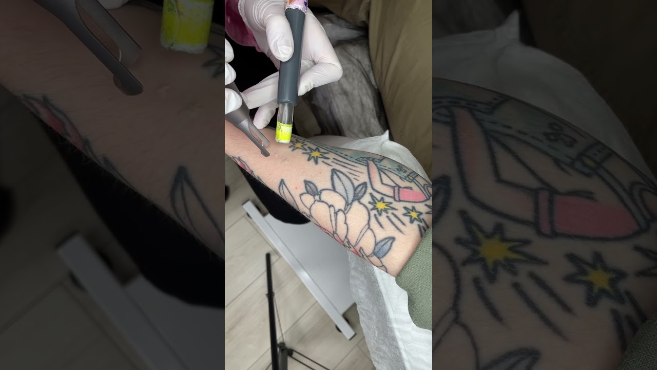 Удаляем тату навсегда 