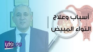 أسباب وعلاج التواء المبيض