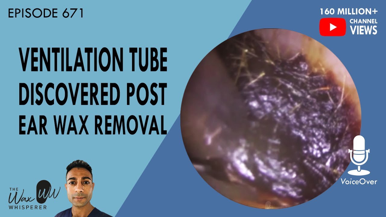 671 Ventilation Tube Discovered Post Ear Wax Removal YouTube