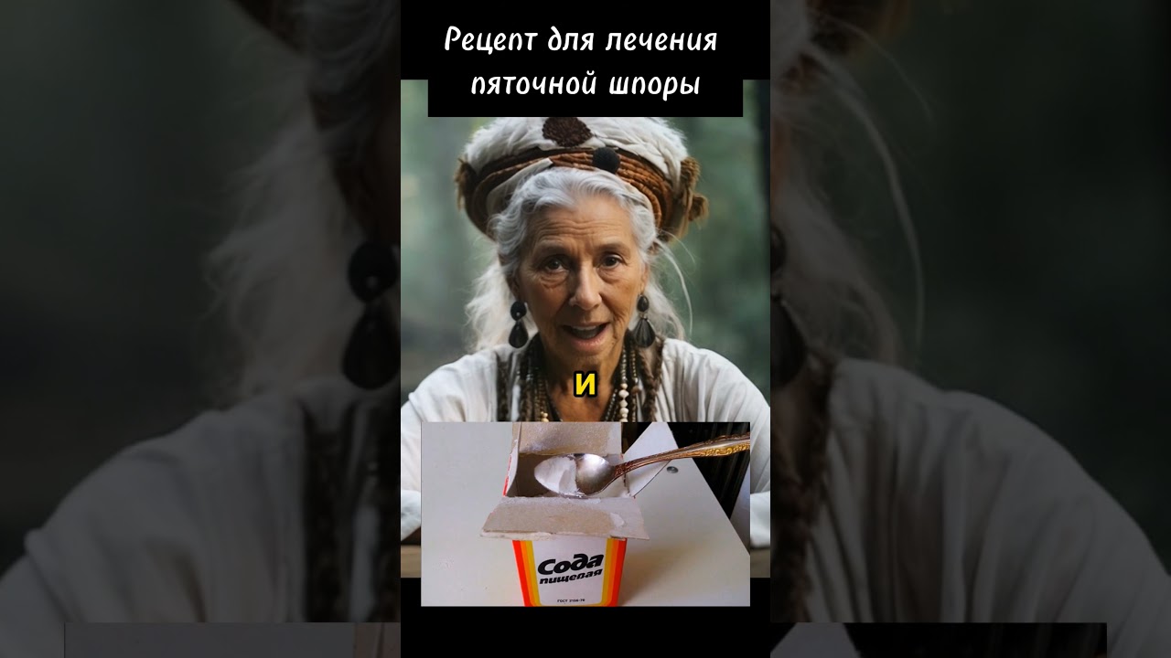 Рецепт лечения пяточной шпоры! #пяточнаяшпора