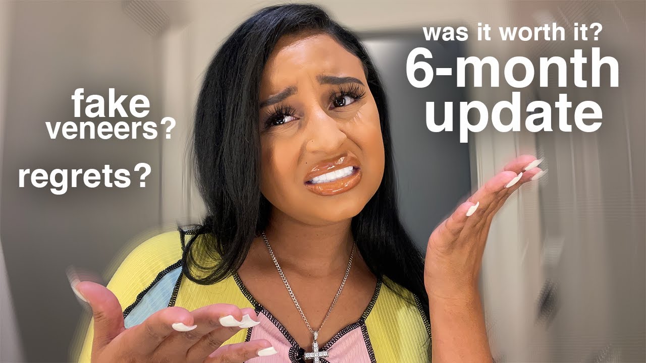 My 6 MONTH Veneers Update! Amatista Estetica Dental! Regrets? 