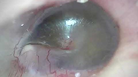What eardrum looks like when doing a Valsalva Maneuver