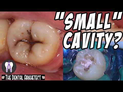 Restoring A Tooth Back To Its Original Shape #C17