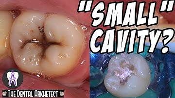 Restoring A Tooth Back To Its Original Shape #C17