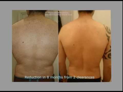 Male back clearance by electrolysis - YouTube