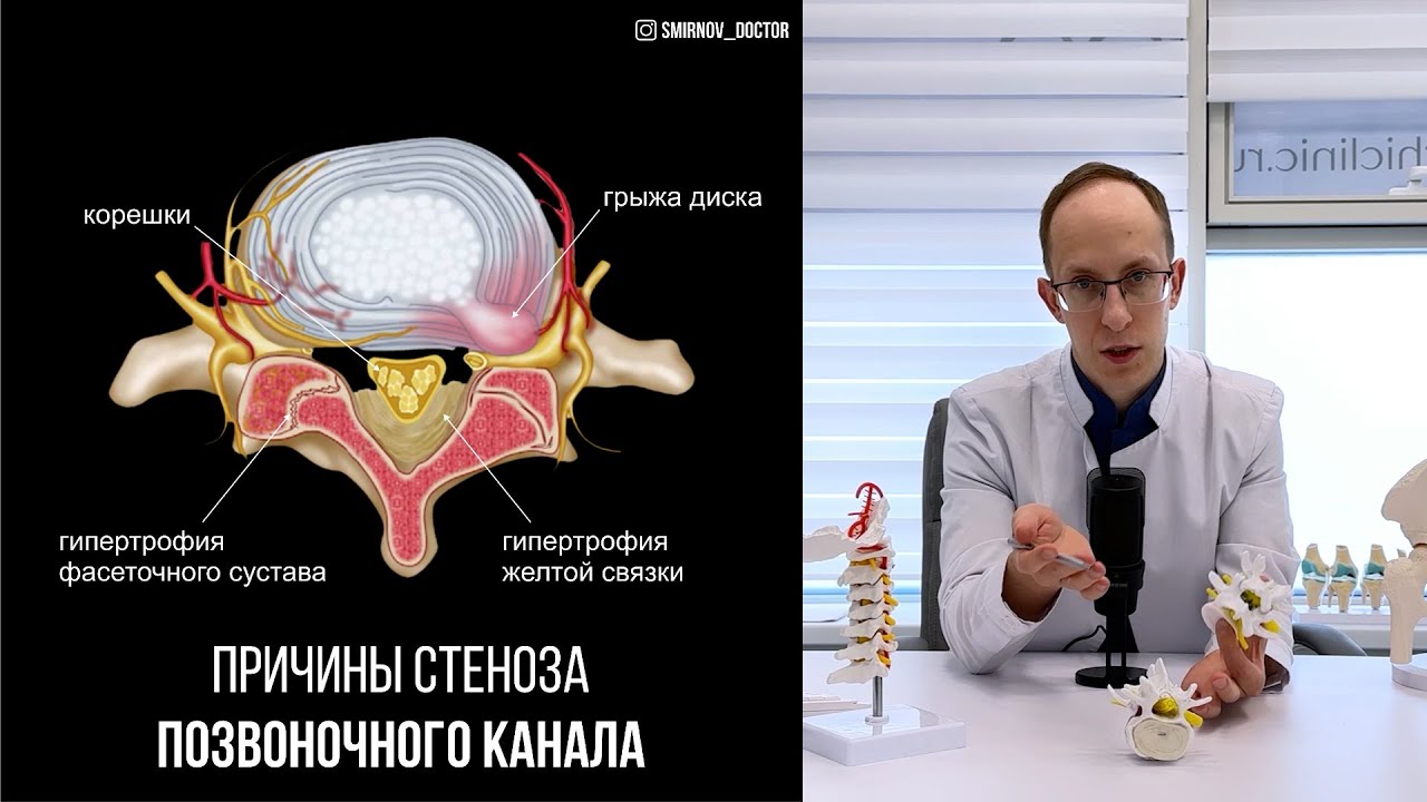 Стеноз позвоночного канала: причины, диагностика и поэтапный план лечения