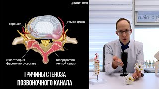 Стеноз позвоночного канала: причины, диагностика и поэтапный план лечения